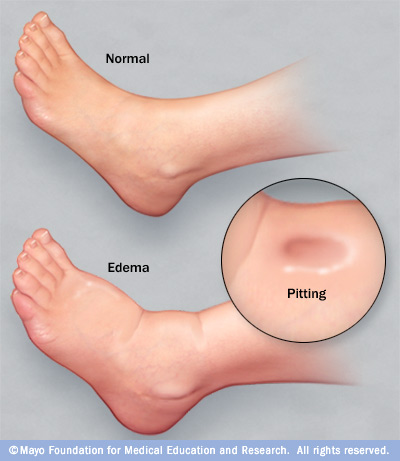 O inchaço nas pernas pode estar relacionado com várias doenças! Procure um médico!
